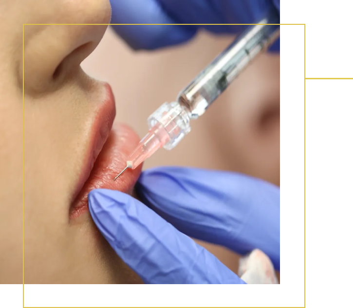 A woman getting her lips filled with botox.