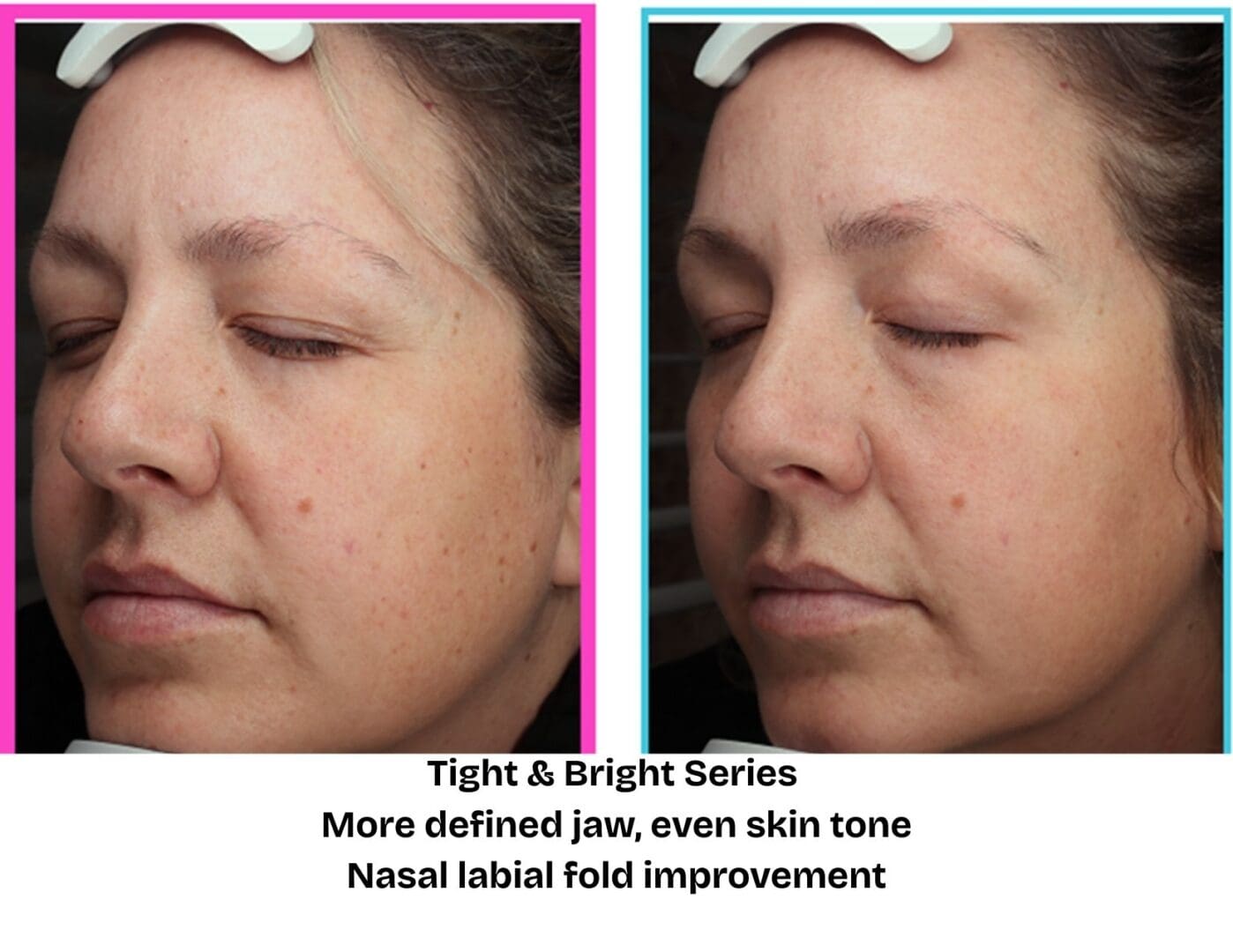 Before and after Tight & Bright skin rejuvenation treatment at Pure Radiance MedSpa showing improved jawline definition, smoother nasolabial folds, and a more even overall skin tone.