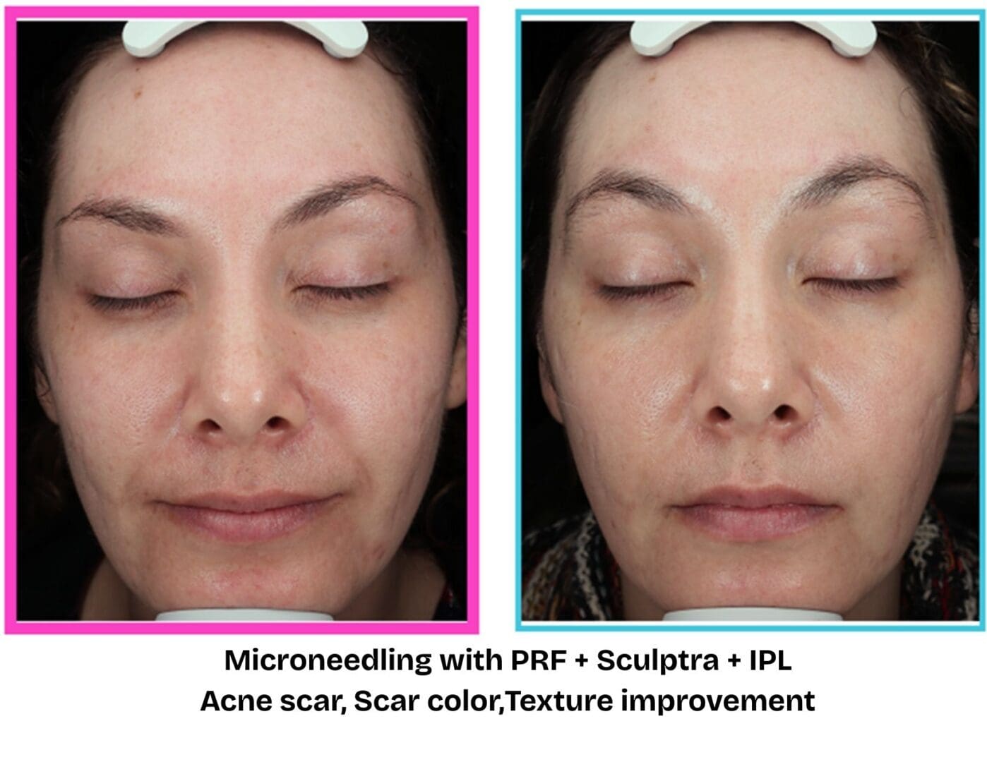 Before and after microneedling with PRF, Sculptra, and IPL treatment at Pure Radiance MedSpa showing improvement in acne scars, skin tone, and overall skin texture.