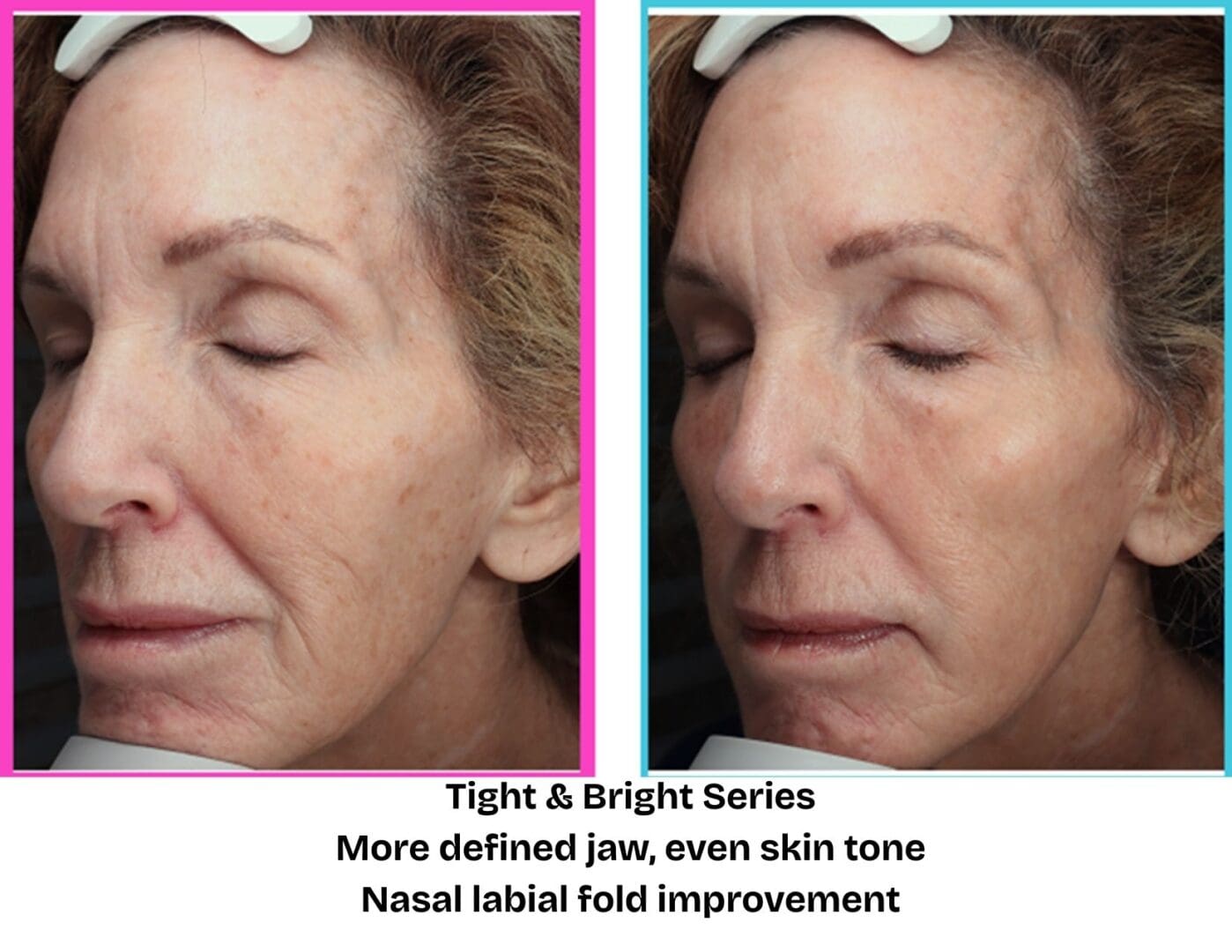 Before and after Tight & Bright treatment series at Pure Radiance MedSpa showing firmer skin, improved facial contour, and more even overall skin tone.