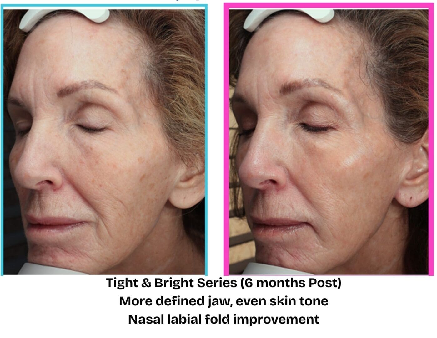 Before and after Tight & Bright skin tightening series at Pure Radiance MedSpa showing smoother skin texture, improved jawline definition, and softer nasolabial folds six months after treatment.