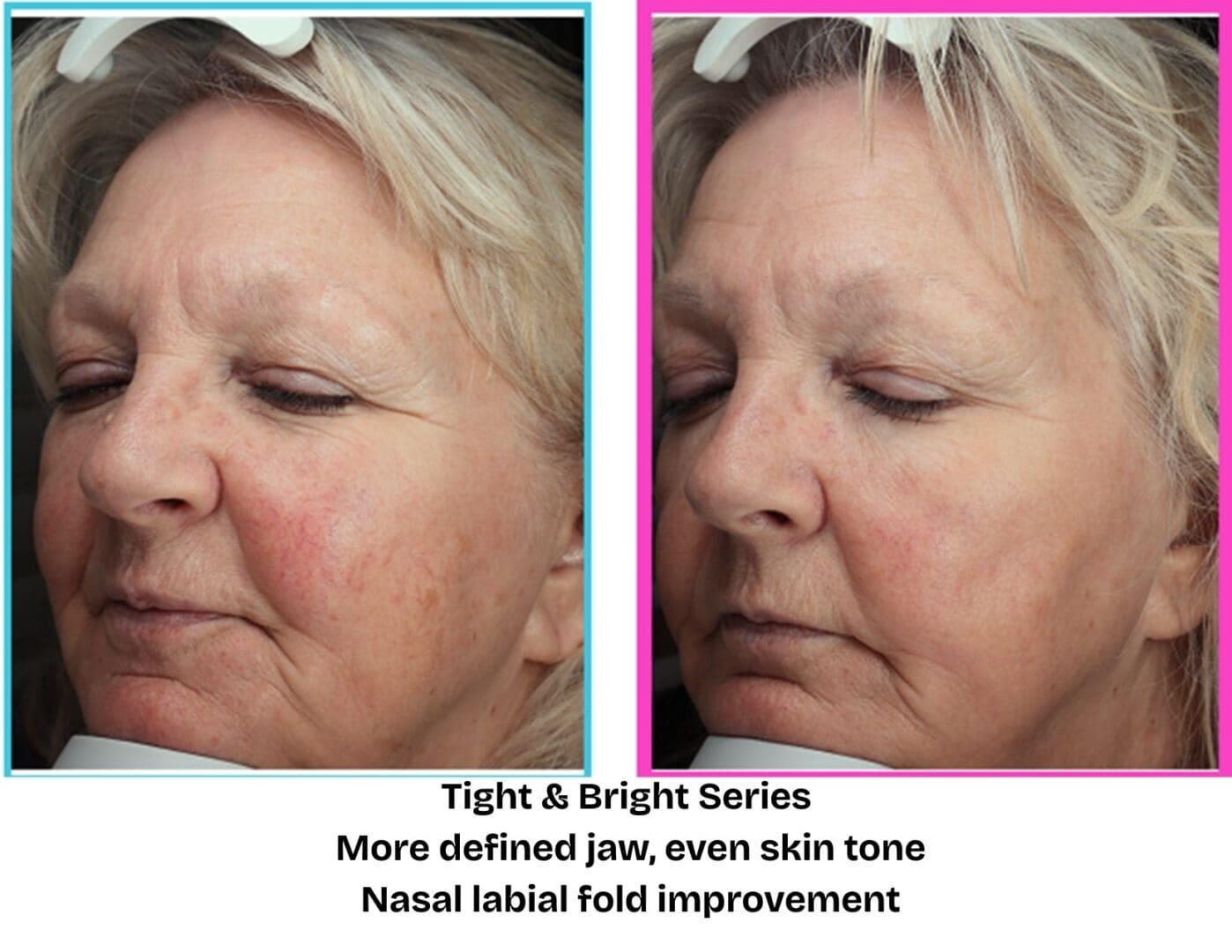 Before and after Tight & Bright skin rejuvenation series at Pure Radiance MedSpa showing reduced redness, improved skin tone, and a more defined jawline.