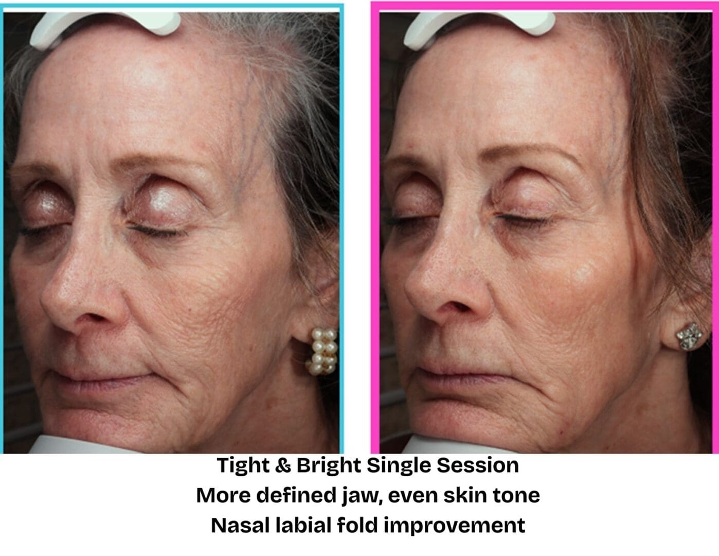 Before and after Tight & Bright skin tightening treatment at Pure Radiance MedSpa showing improved jawline definition, smoother nasolabial folds, and a more even skin tone after one session.