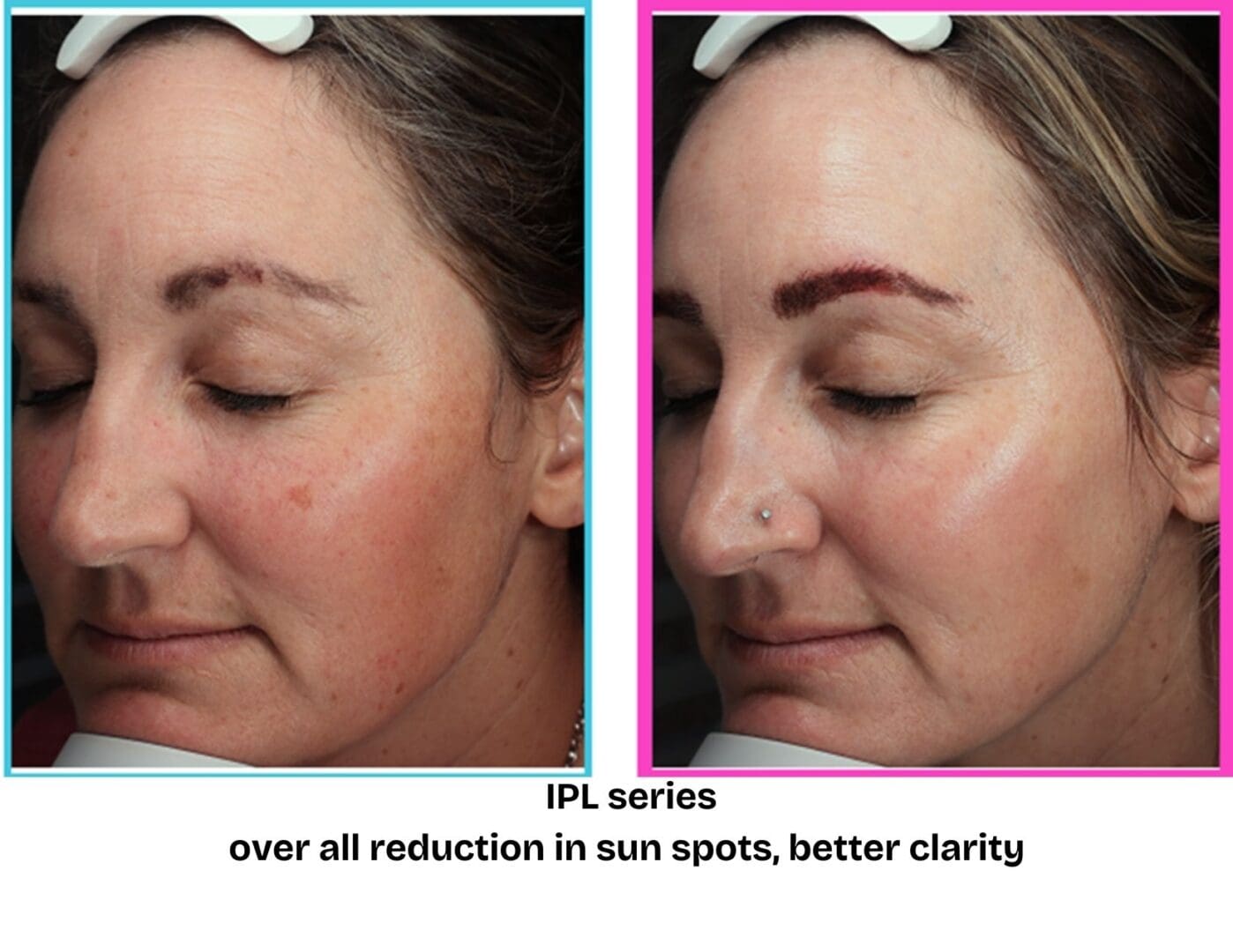 Before and after IPL photofacial treatment at Pure Radiance MedSpa showing reduced sun spots, improved skin clarity, and more even skin tone.
