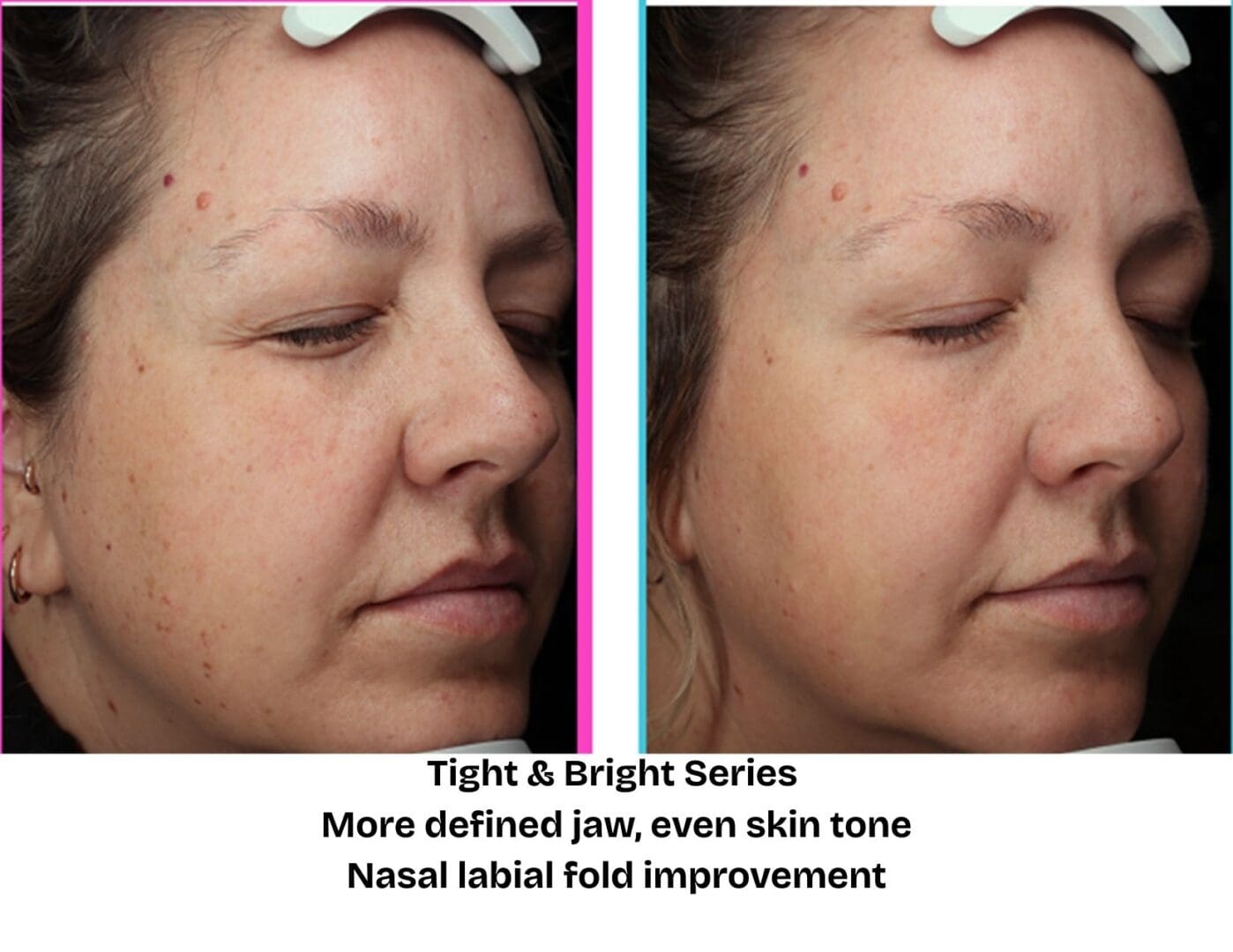 Before and after Tight & Bright skin tightening treatment at Pure Radiance MedSpa showing firmer skin, improved facial contour, and a more balanced skin tone.