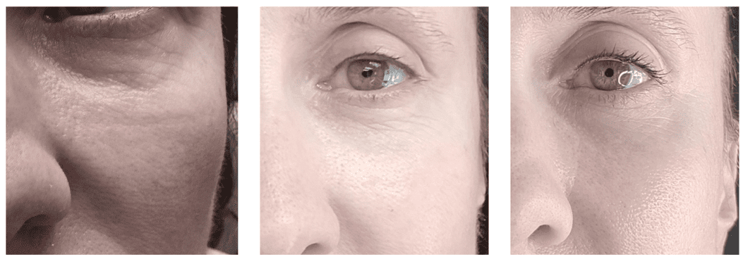 Pure Radiance Under-Eye PRP Colorado Springs