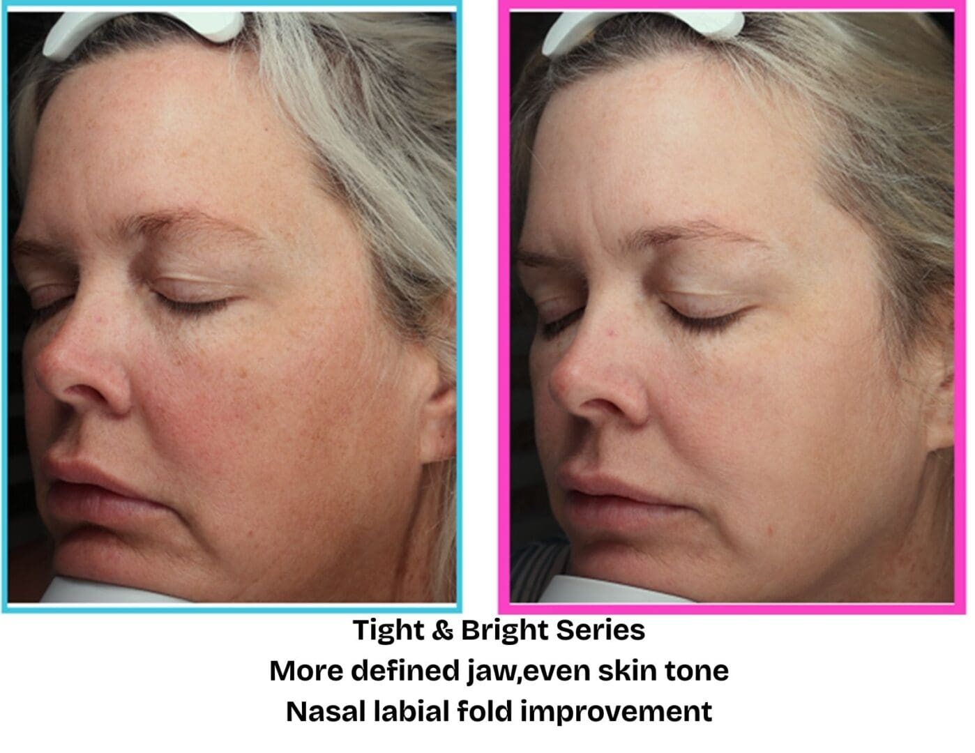 Before and after: jawline and skin laxity improvement at Pure Radiance MedSpa in Colorado Springs