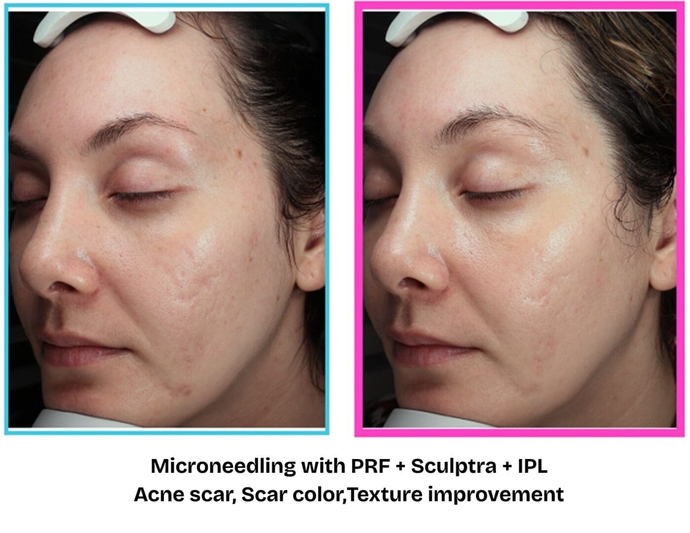 Before and after: acne scarring and texture improvement after treatment at Pure Radiance